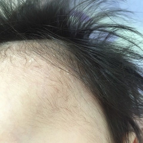 各位宝妈帮我分析下我家宝宝额头上起的干皮是不是湿疹