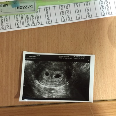 双胎男孩孕囊图片图片