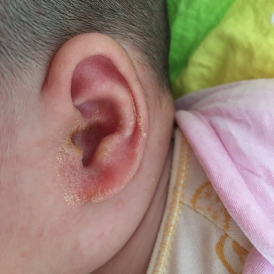 婴儿耳朵有黄粘液图片