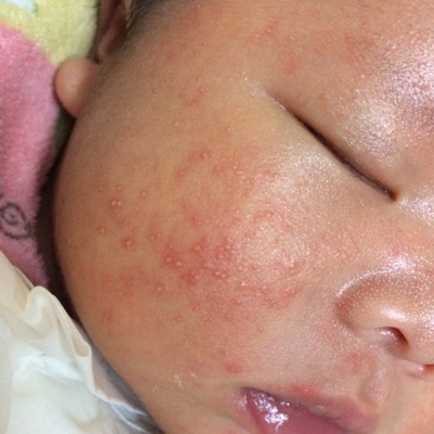 宝宝12天了,脸上长了好多小痘痘还带点黄,怎麼办