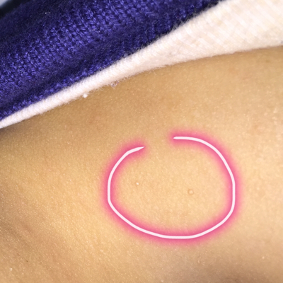 宝宝15个月大 脖子周围长了些图片上的颗粒 类似脂肪粒 摸上去硬硬的