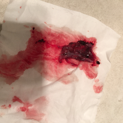 4月1号早上开始出现流褐色的血,第二天去医院打了