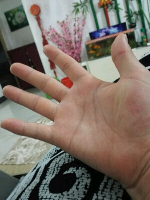 孕期手好像水肿了,有时左手肿点,有时右手肿,要怎麼办,大家有这样吗