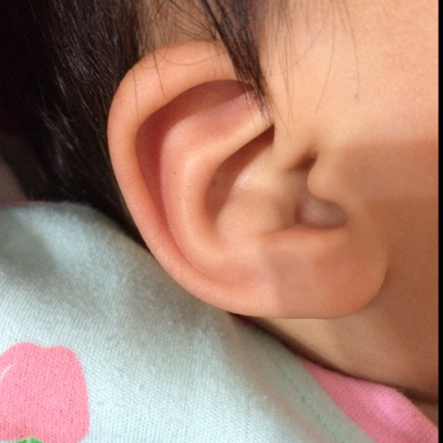我宝宝现在1周5,在她1周左右的时候右耳外耳廓那里长了个小软包,不