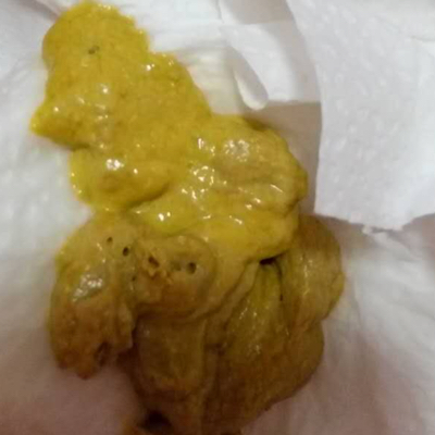 我女儿5个月零11天,大便起来老是很用力而且脸涨的通红很吃力的样子.