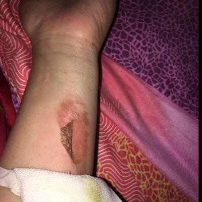 怀孕八个多月了,烫伤了可以用京万红软膏吗?急急急急急急急