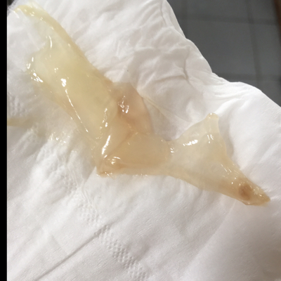 今天排尿,突然感觉有东西出来,拿纸一擦,出来这麼个