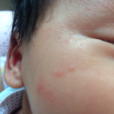 新生儿湿疹和痤疮图片图片