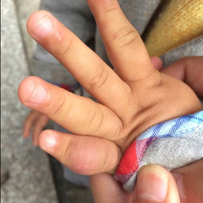 宝宝天生左手小手指肥大,拍片子骨头是好的,有没有类似的宝妈有什麼好