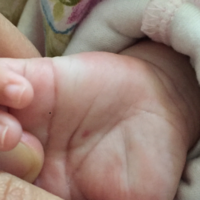 宝宝手掌有红斑点图片图片