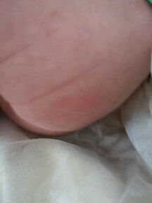 宝宝屁股上有好多红色的疹子,是不是纸尿裤过敏,纸尿裤用的是安儿乐