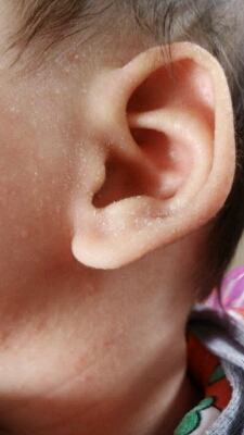 请问我家宝宝耳朵上是怎麼了,后面都烂了