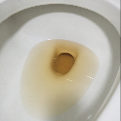 棕褐色尿液图片