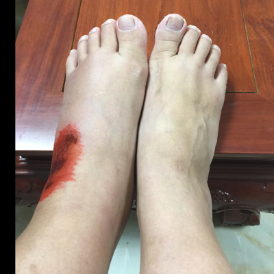 孕23周摔伤扭到左脚,现脚面红肿发黑,孕妇不能擦药贴药膏,求大神支招!