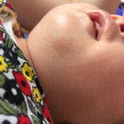宝宝脸上荨麻疹图片图片