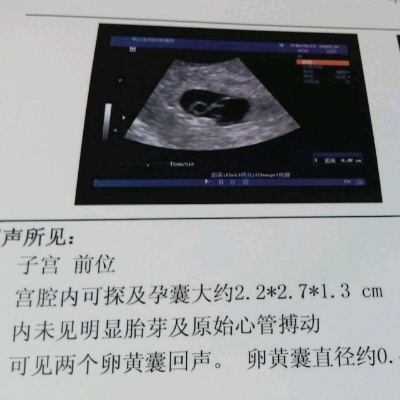 有2个卵黄囊回音,就是没有胎芽和心管搏动,怀孕2月了怎么回事