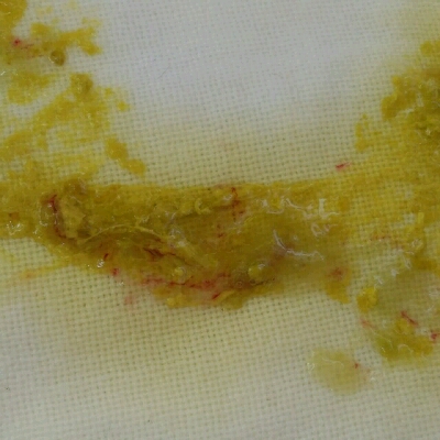 宝宝大便带血丝 ,拉肚子一个多月了 ,吃药吃了一个多月了 还是不见好