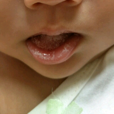 宝宝舌头有小白泡图片图片
