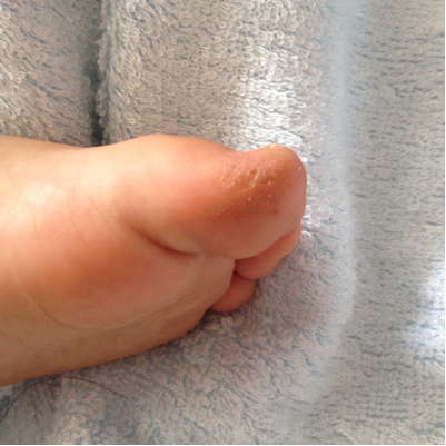 宝宝一岁三个月了,会走路快两个月了,发现他的左脚大脚趾外侧发黄皮硬