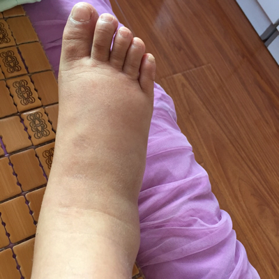 脚都肿成面包了,怎麼办?