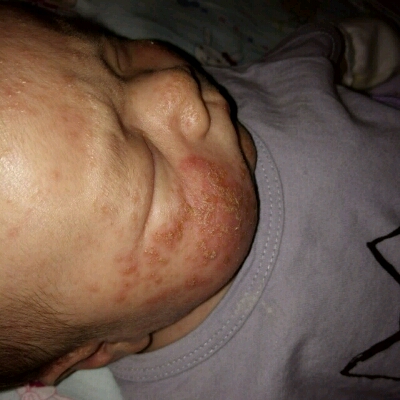宝宝脸上得了湿疹,都流脓了,去医院看了,拿的药膏擦了不管用,看着好