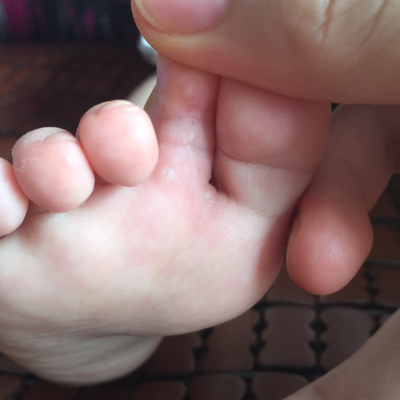 怎么判断宝宝是脚气图片