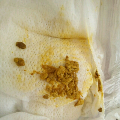 问答 婴儿期0-1岁 宝宝树孕育 90%的妈妈正在使用 宝宝树孕育 90%的