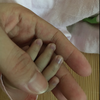 6个月宝宝下唇有淤紫图片