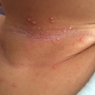 宝宝脖子长这样怎麼办