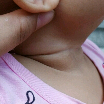 2个月宝宝颈部有白斑图片