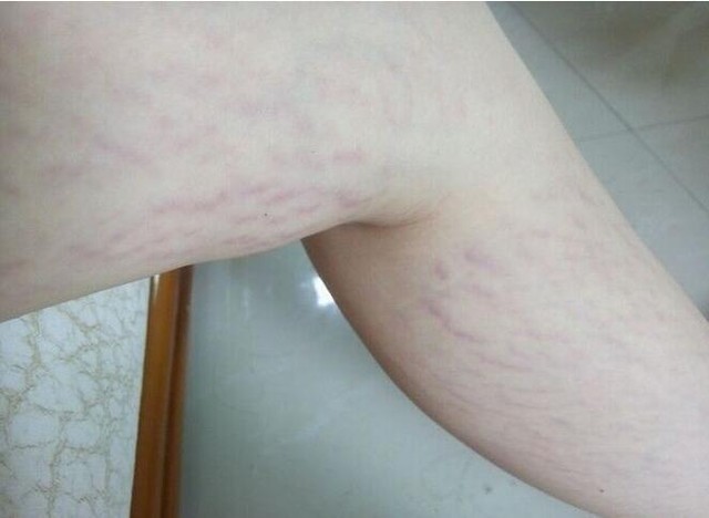 怎么改善妊娠纹?好烦呐