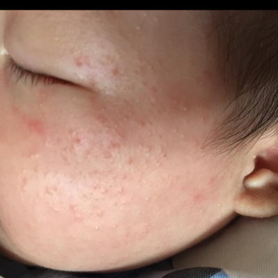 宝妈们,宝宝现在一个多月大,脸上长了这种疹子,是热疹还是湿疹吗?